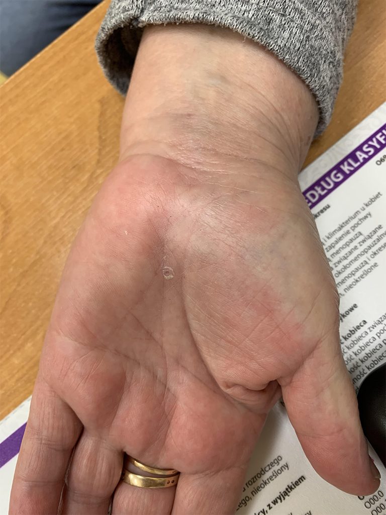 cieśń nadgarstka leczenie