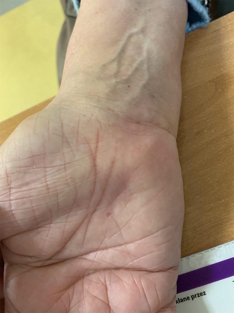 zespół cieśni nadgarstka