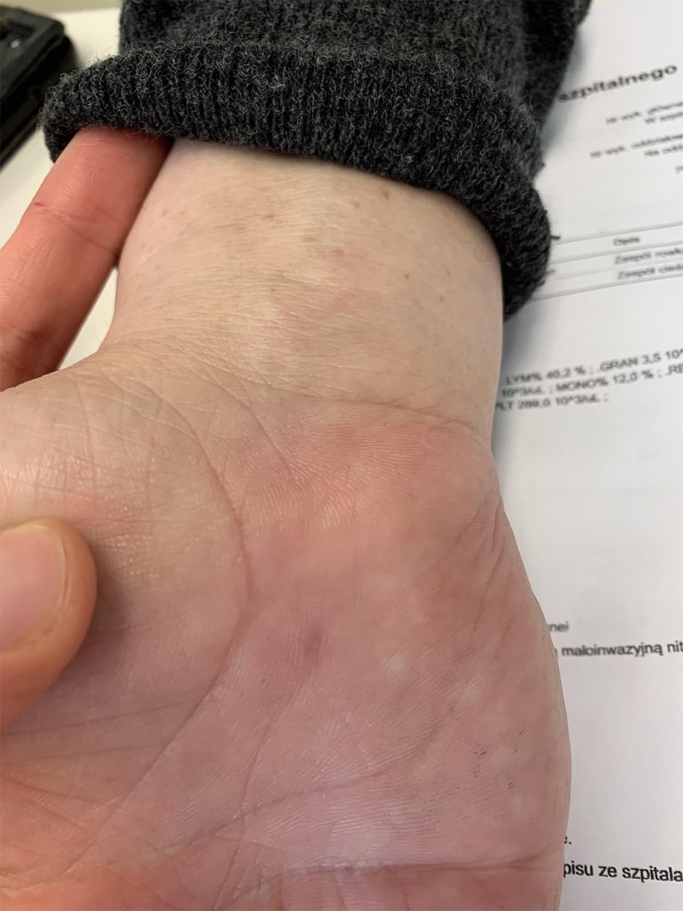 zabieg cieśnia nadgarstka