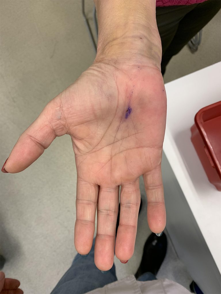 cieśń nadgarstka zabieg