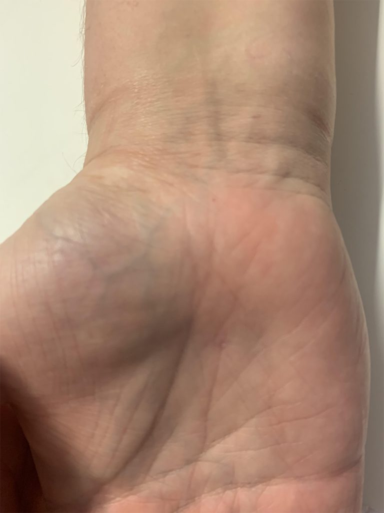 zabieg na cieśń nadgarstka